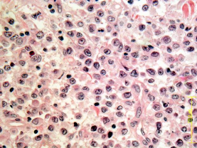 Fig.1: DLBCL-H-E - <div style=